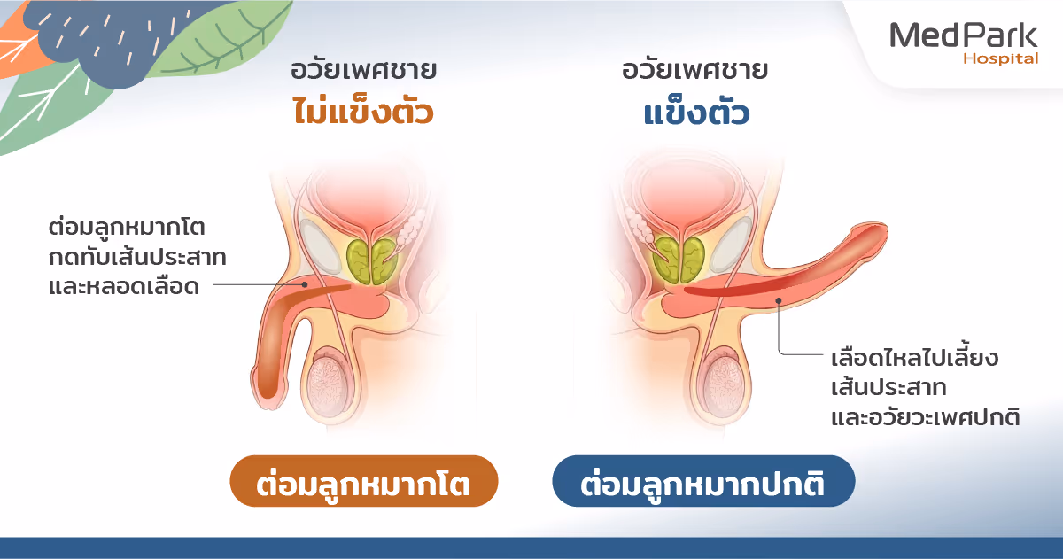 เปรียบเทียบก่อนผ่าตัดและหลังผ่าตัดต่อมลูกหมากด้วยเลเซอร์ HoLEP