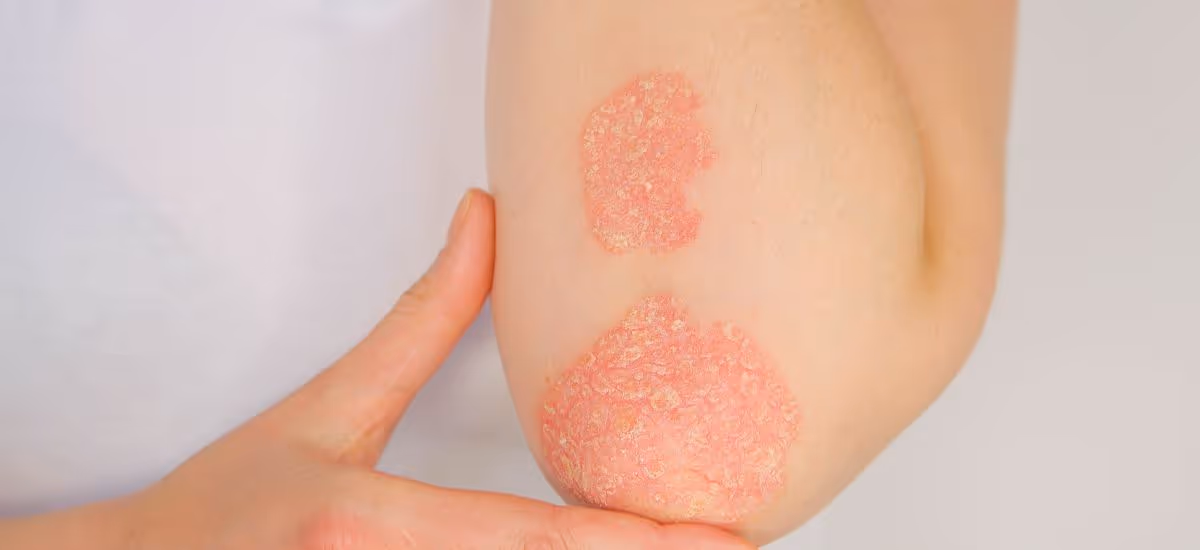 Psoriasis-symptoms of psoriasis