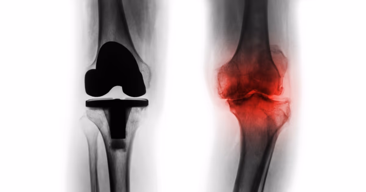 รูปเปรียบเทียบ ข้อเข่าทั้งข้อ และ โรคข้อเข่าเสื่อมระยะรุนแรง