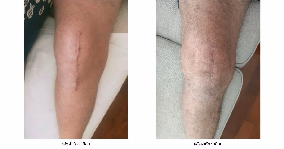 Knee Replacement Surgery Journey
