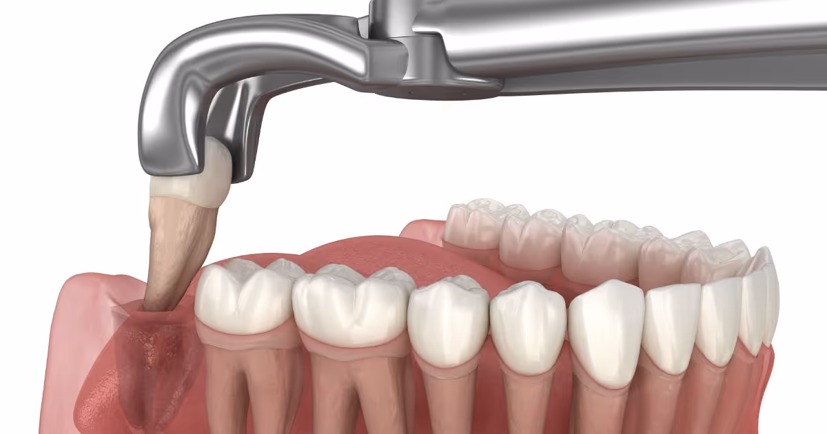 ขั้นตอนการผ่าฟันคุด What is the wisdom tooth removal procedure?