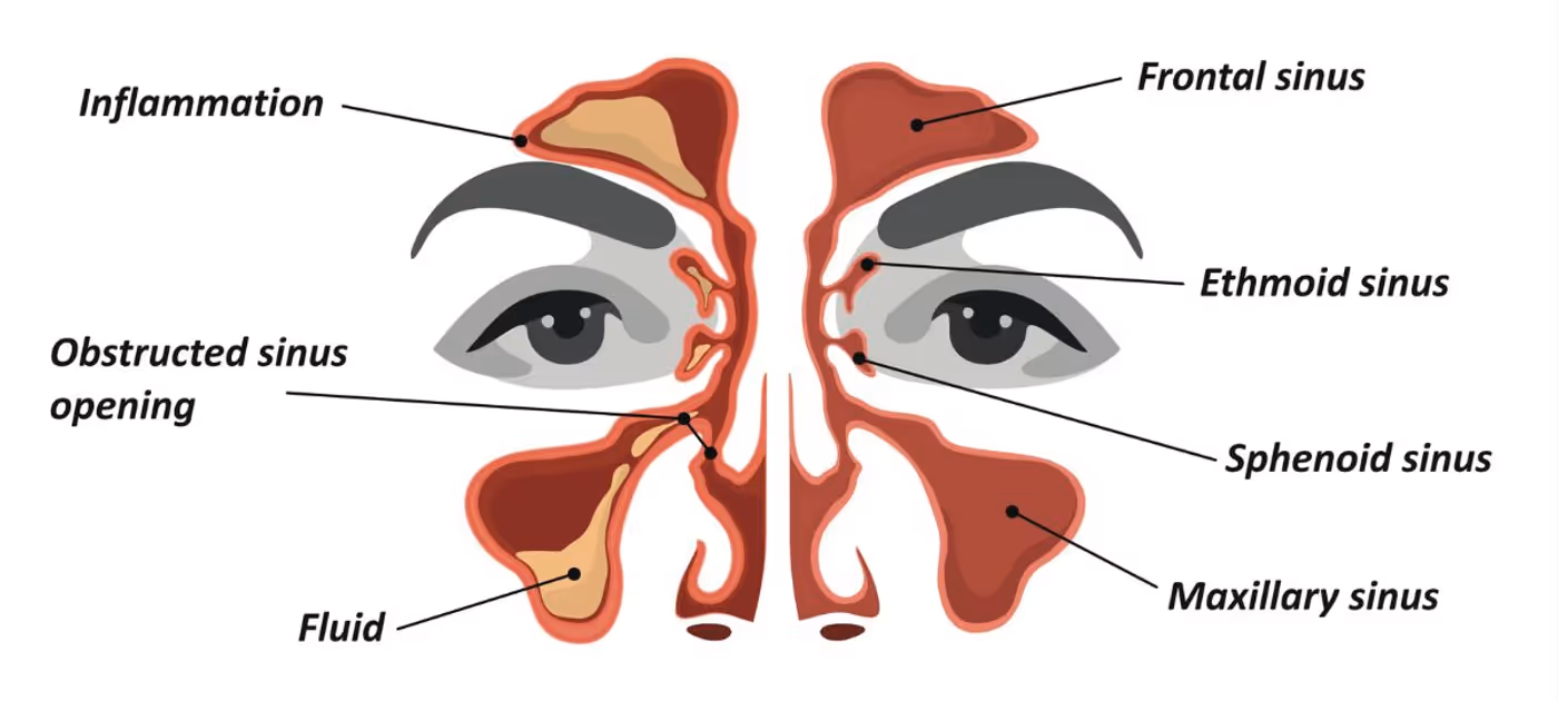 Complications of acute sinusitis