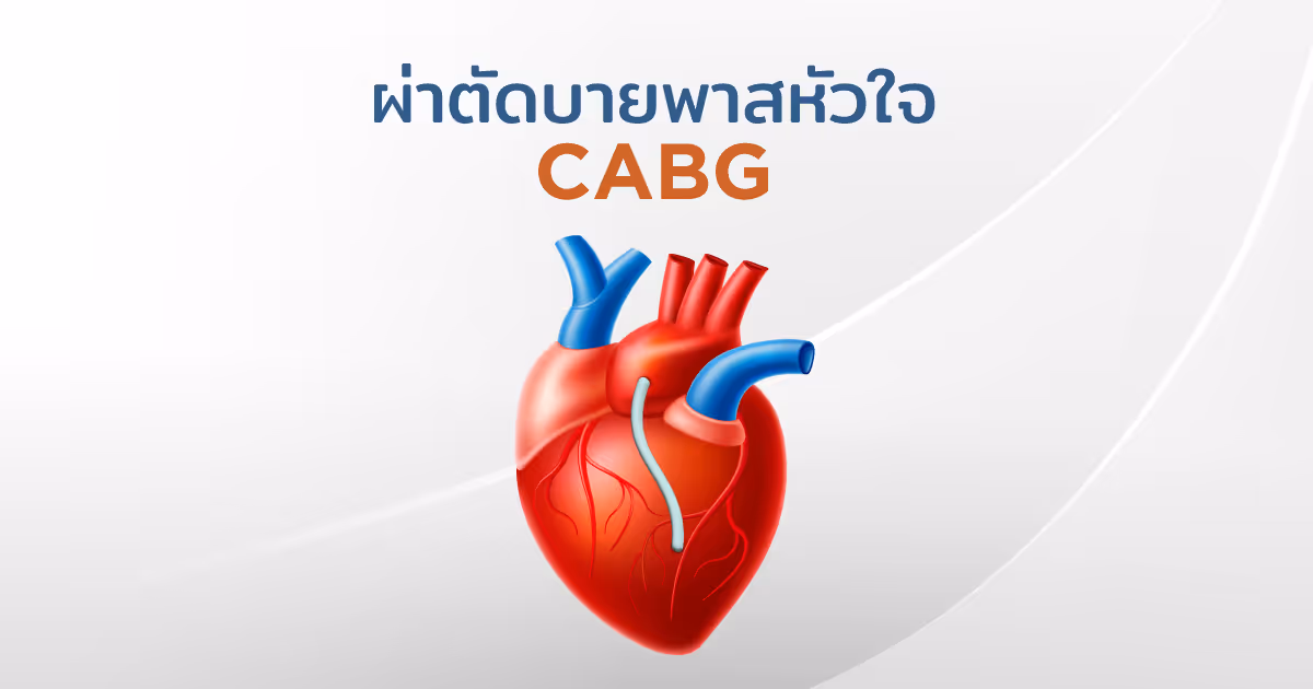 ผ่าตัดบายพาสหัวใจ-Coronary Artery Bypass Grafting (CABG)