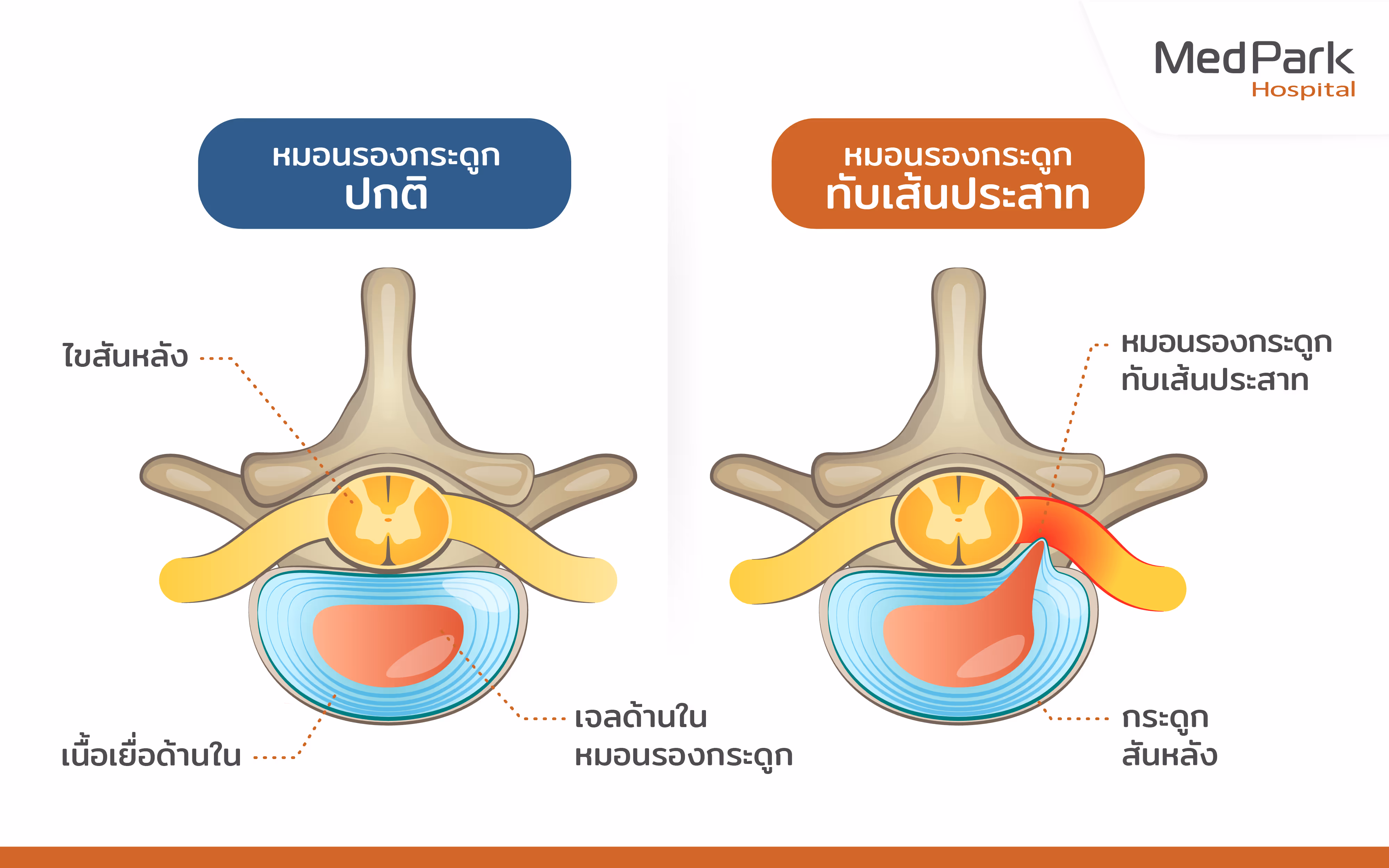 ภาพแสดงอาหารหมดรองกระดูกทับเส้นประสาท - Herniated disc