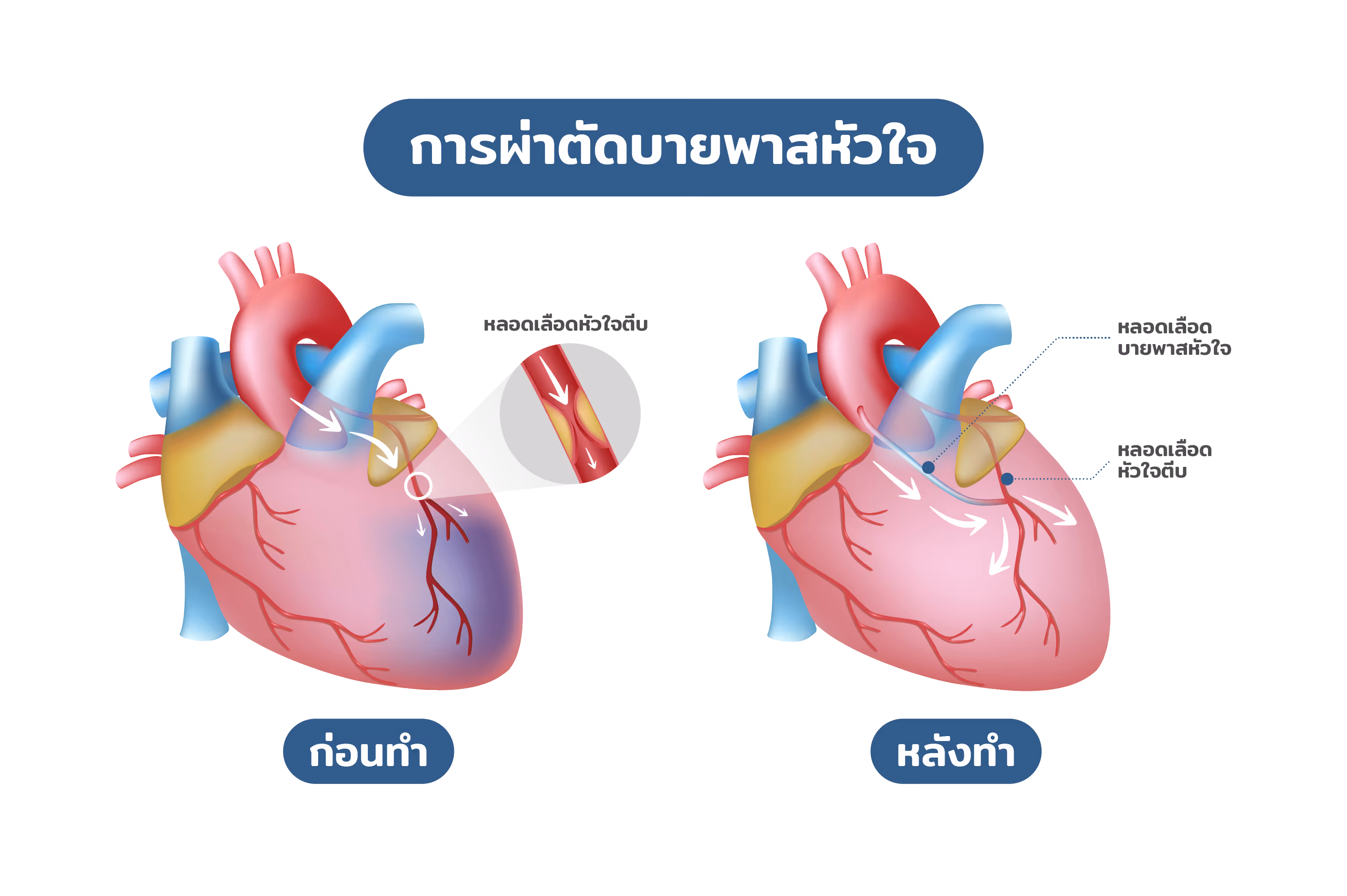 ขั้นตอนผ่าตัดบายพาสหัวใจ-CABG procedure