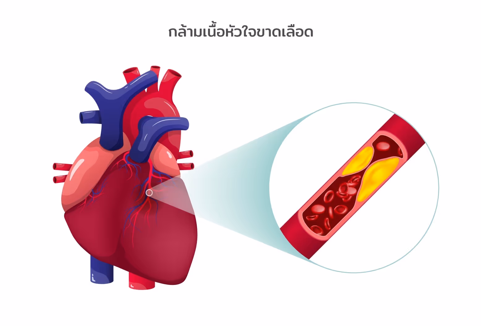 ผ่าตัดบายพาสหัวใจรักษาโรคอะไร-Diseases can be treated with CABG