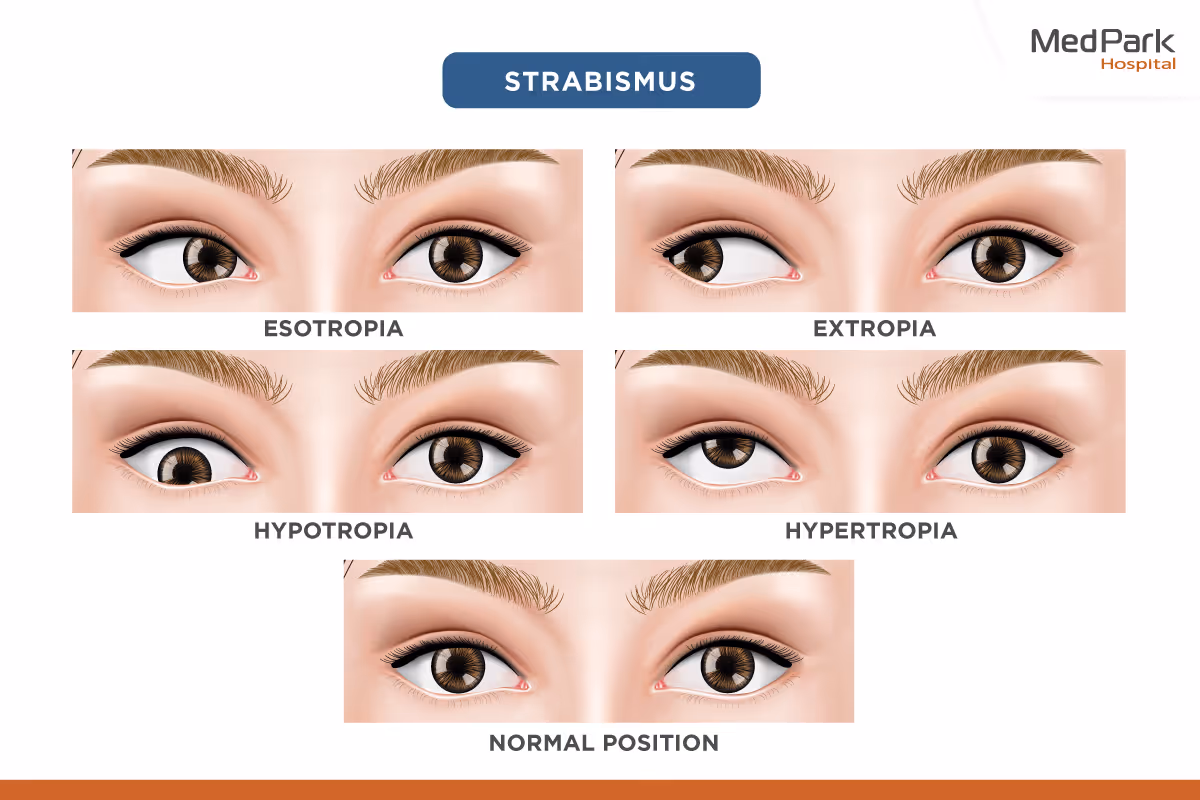 What Are the Types of Strabismus (1)