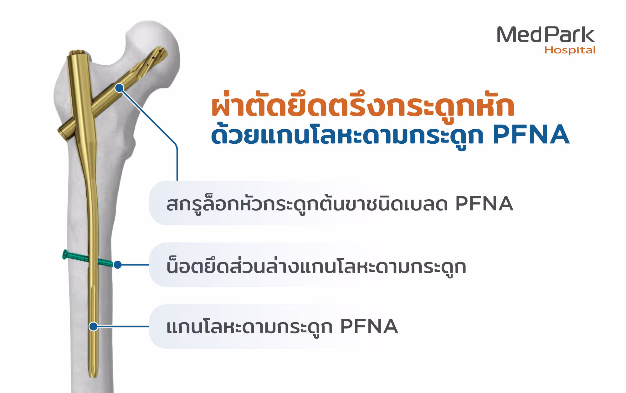 ผ่าตัด PFNA มีขั้นตอนอย่างไร What is the PFNA surgery procedure?