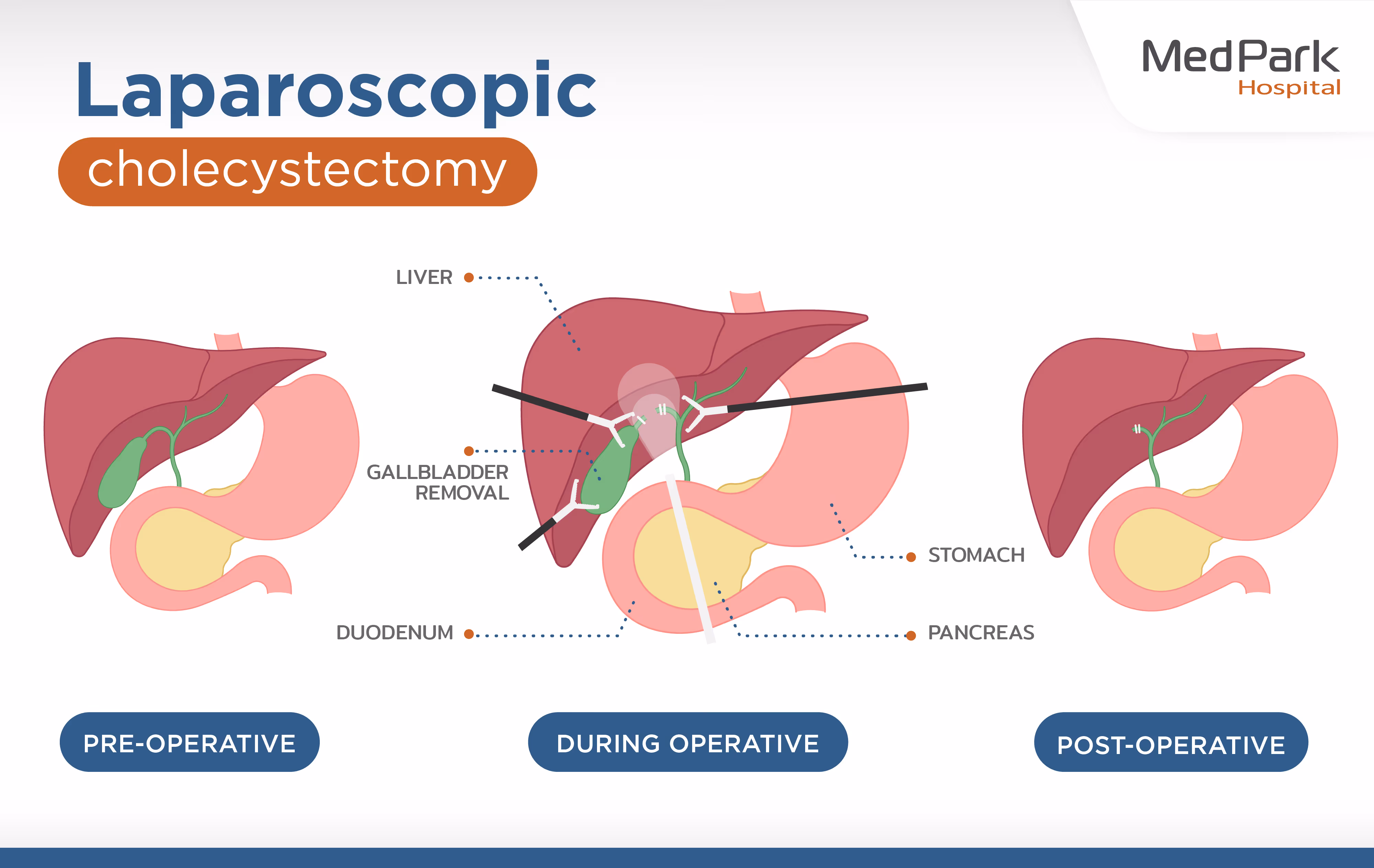 laparoscopic cholecystectomy procedure