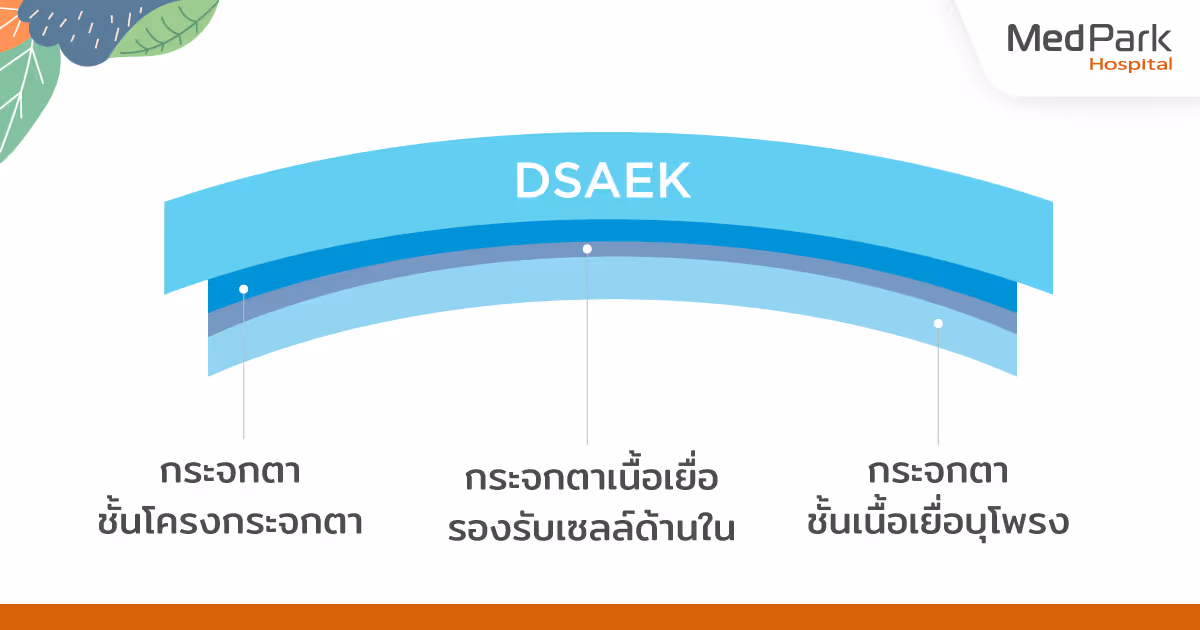 ดูแลตนเองหลังการผ่าตัดเปลี่ยนกระจกตา DSAEK - Dsaek Cornea Surgery