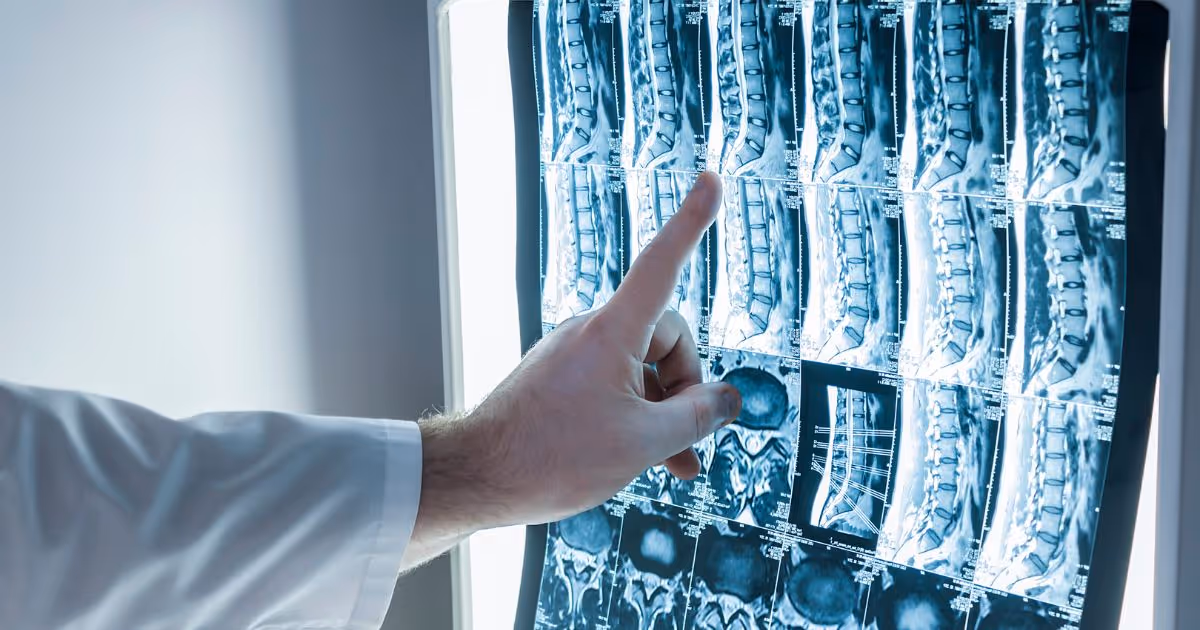 What Can MRI of the Spine Detect?