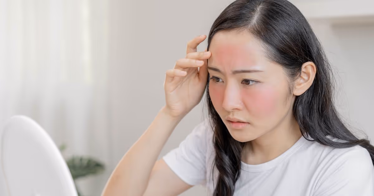 อาการ การรักษาผิวไหม้แดด และการฟื้นฟูผิว - Sunburn: Symptoms, Treatment and Prevention