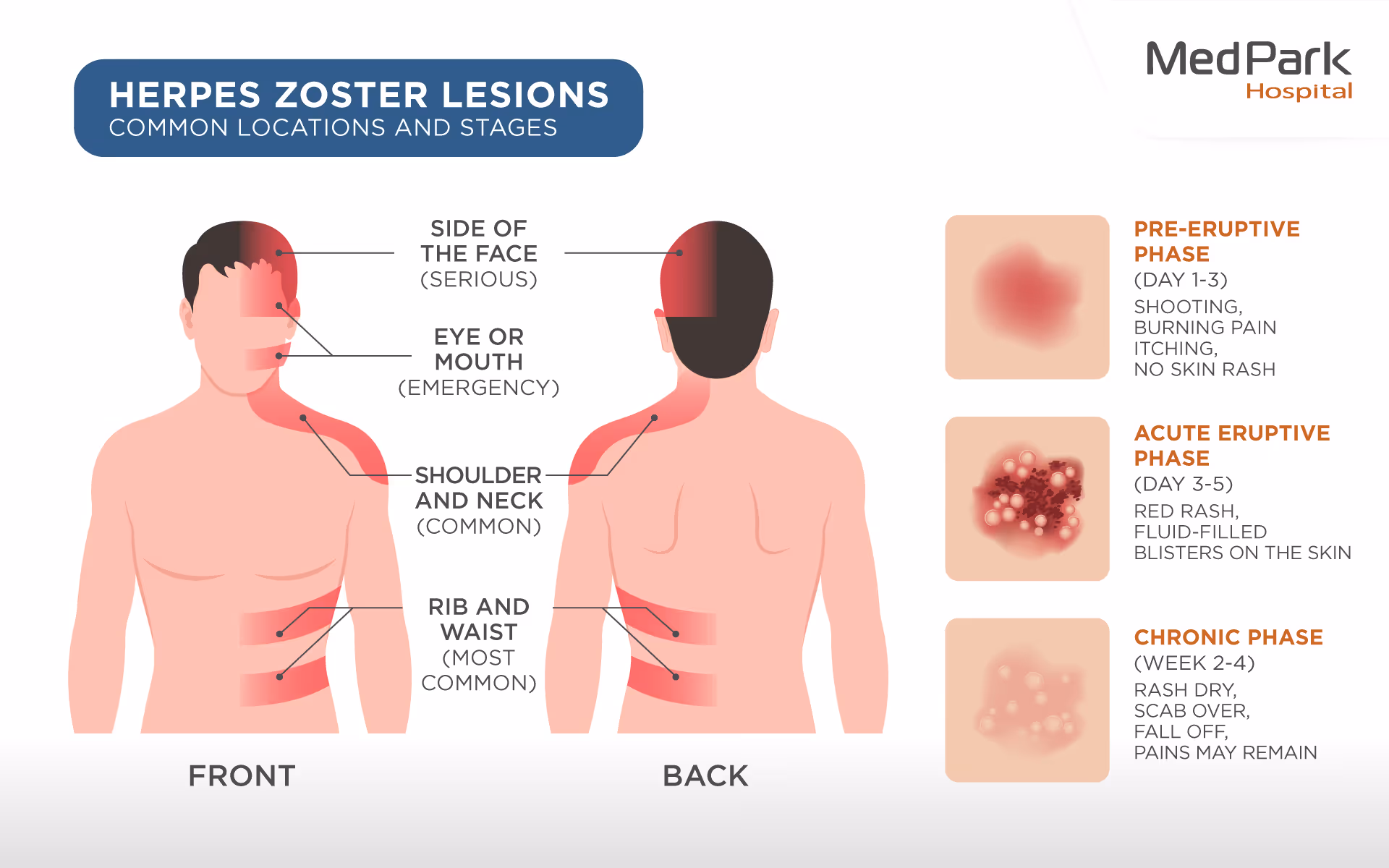 Herpes Zoster Stages