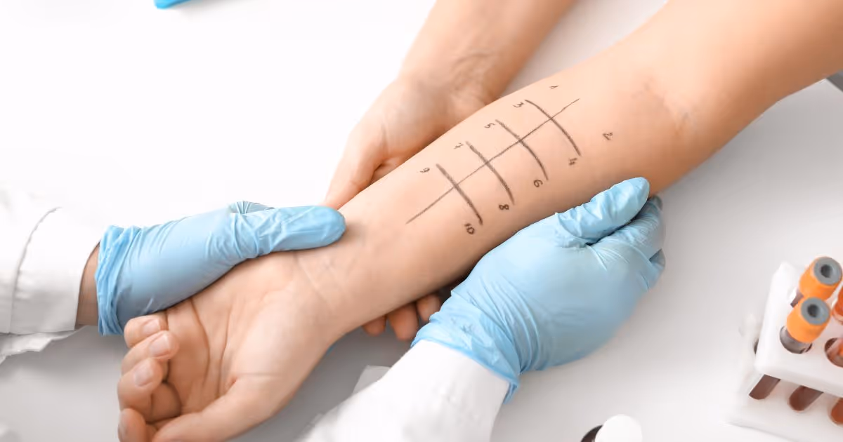 ทดสอบภูมิแพ้ทางผิวหนัง (Skin Prick Test) ขั้นตอน ข้อดี กี่วันรู้ผล - Skin prick test: Procedure, Benefits, Turnaround time