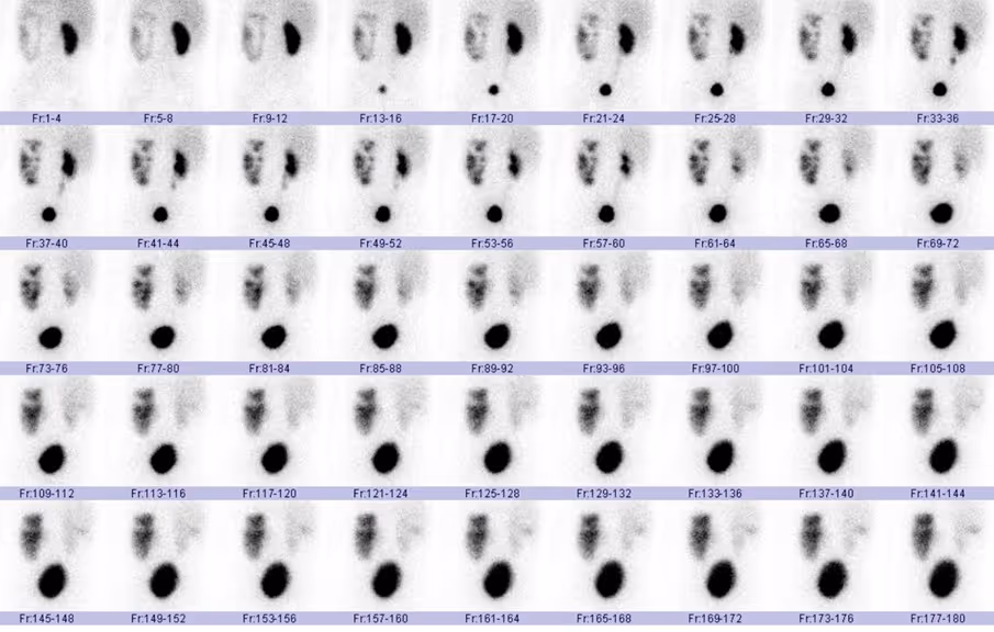 การถ่ายภาพรังสีของไต (Renal Scan)
