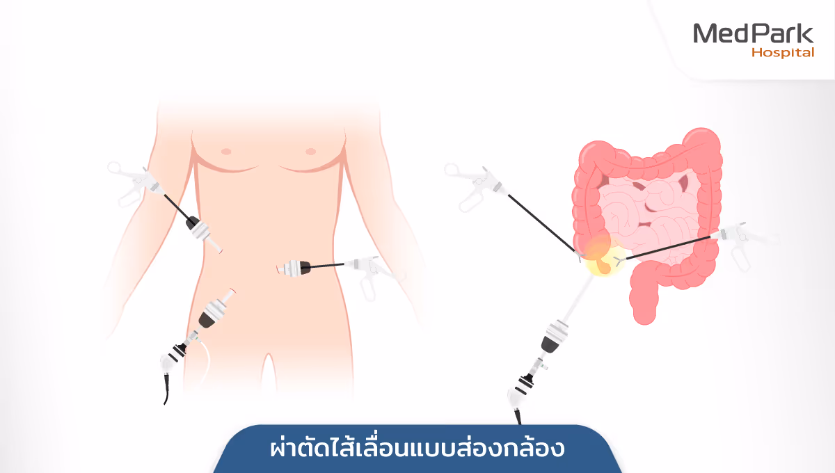 Aw Laparoscopic Herniorrhaphy 2 Th