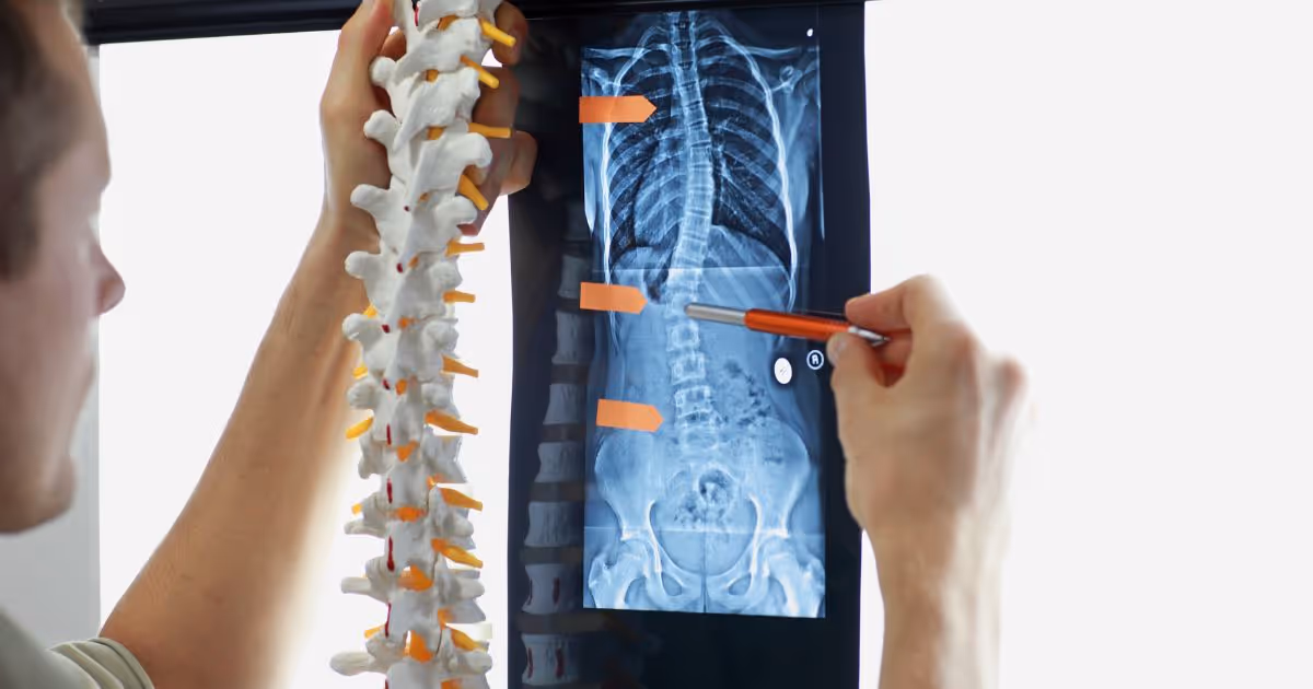 โรคกระดูกสันหลังคด (Scoliosis) สาเหตุ การตรวจวินิจฉัยและการรักษา - Scoliosis - Causes, Diagnosis and Treatment