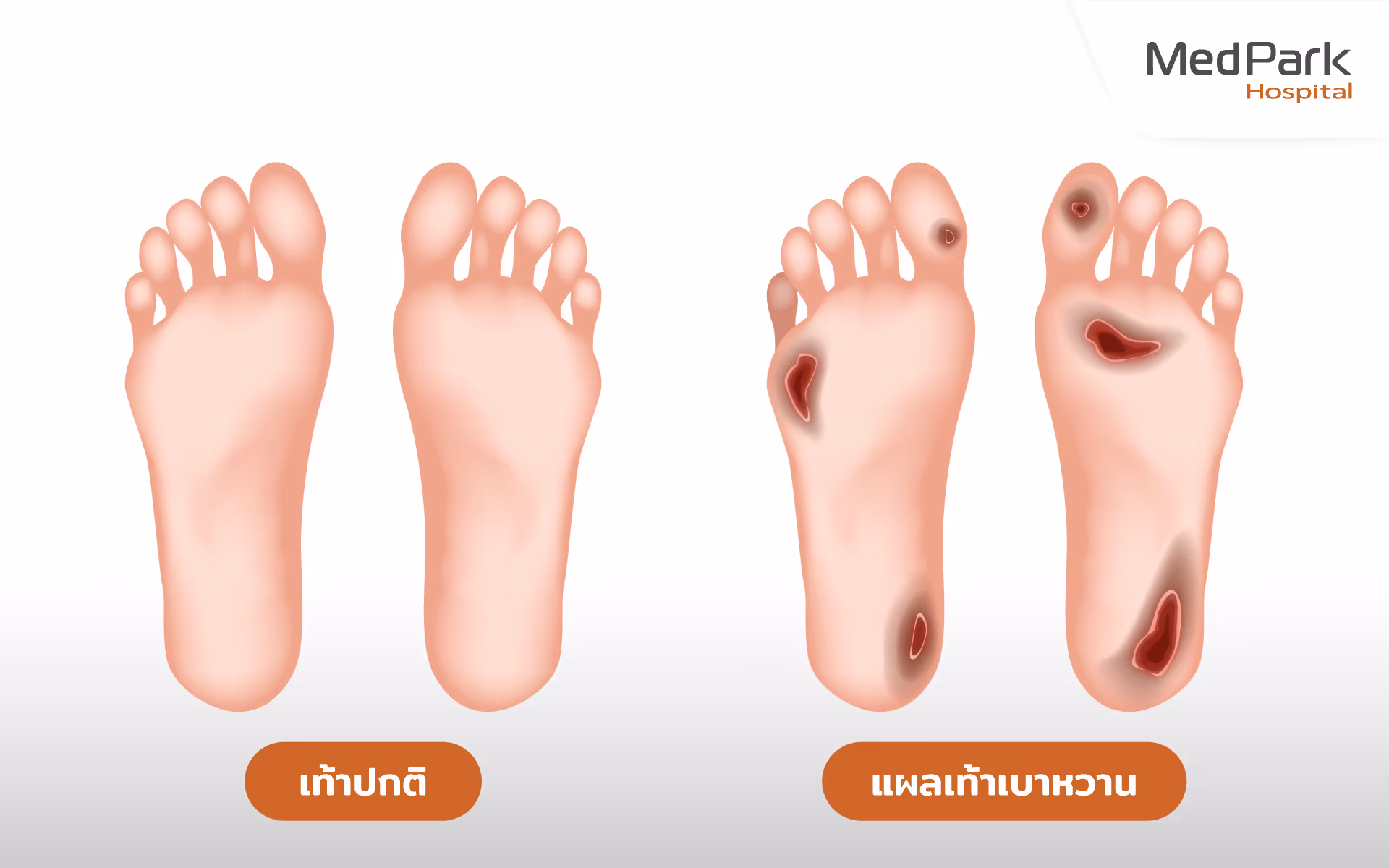 Hyperbaric Oxygen Therapy 1