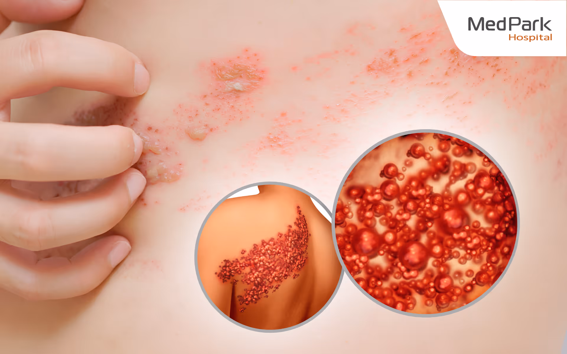 งูสวัดภาวะแทรกซ้อน-Herpes zoster complications