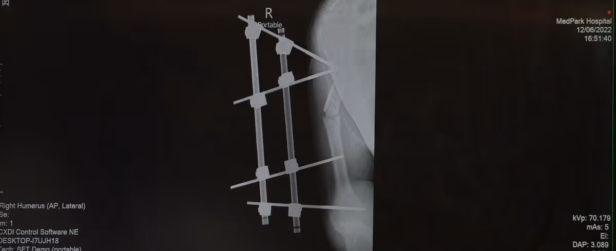 Right Humerus 2