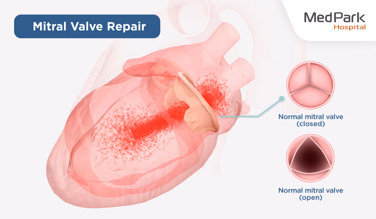What Is the Mitral Valve Repair Procedure En