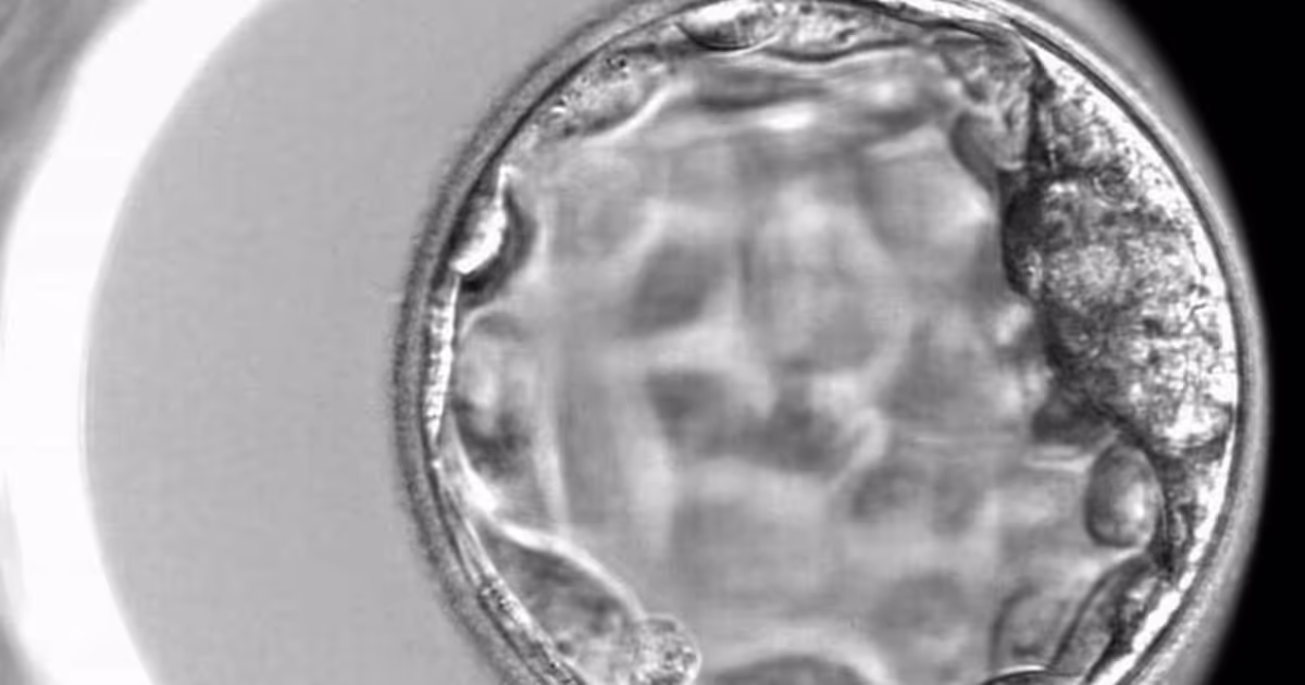 การแบ่งเกรดตัวอ่อน สำหรับทำเด็กหลอดแก้ว - IVF Embryo Grading