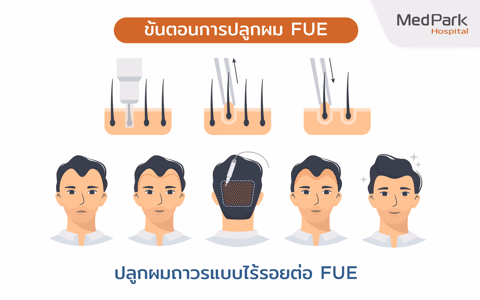ขั้นตอนการปลูกผม FUE