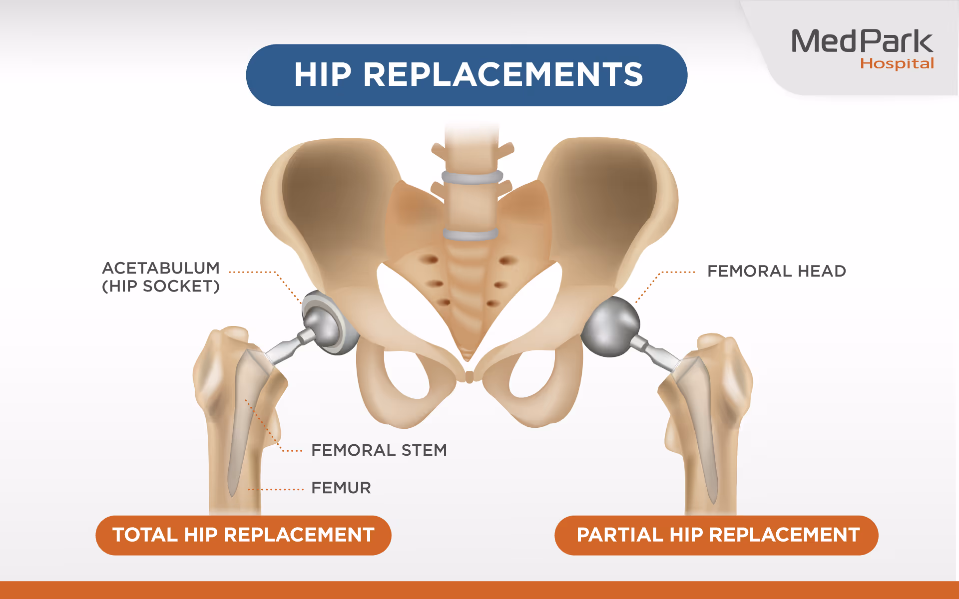 Hip Replacement En 2