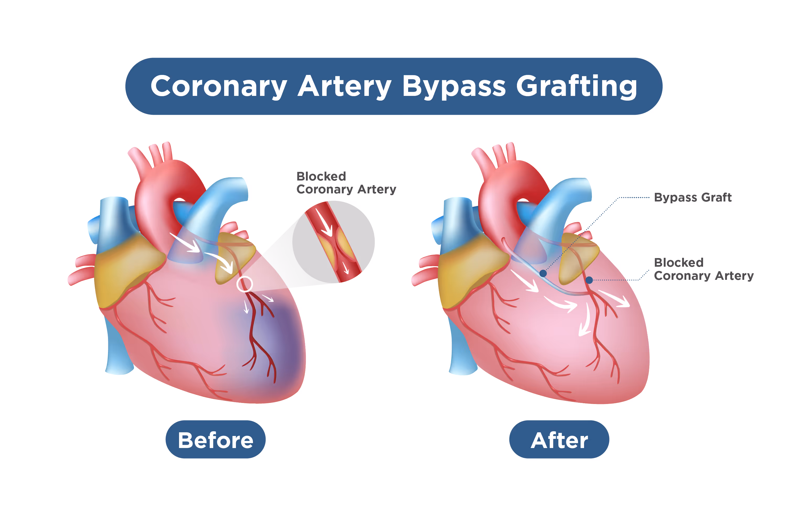What is a coronary artery bypass grafting procedure?