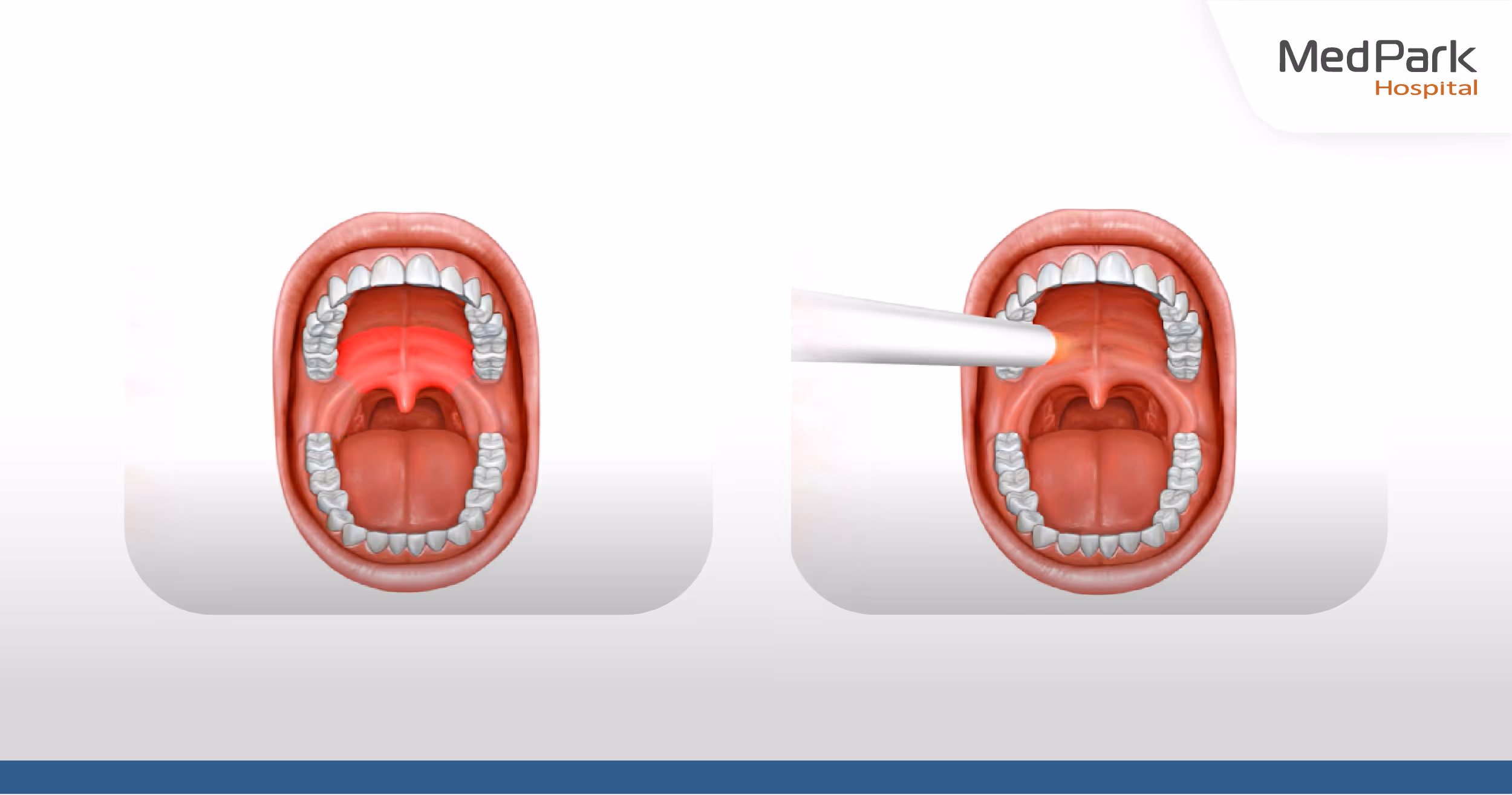 During NightLase laser snoring treatment