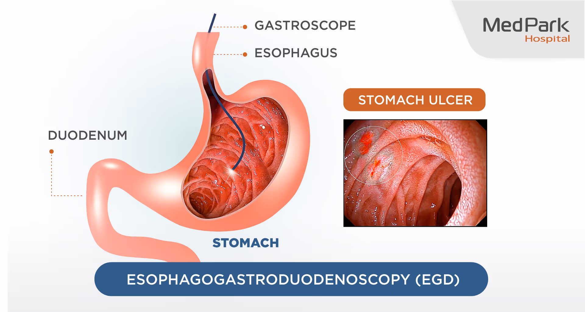 How is GERD diagnosed?