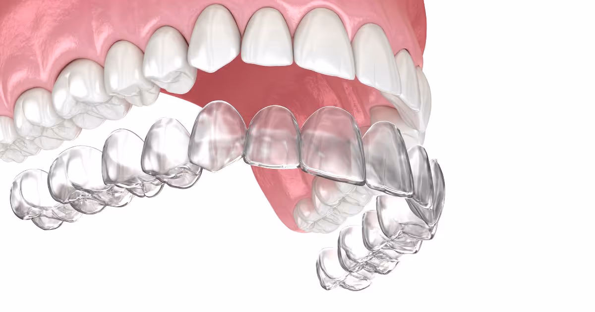 Invisalign Banner 2