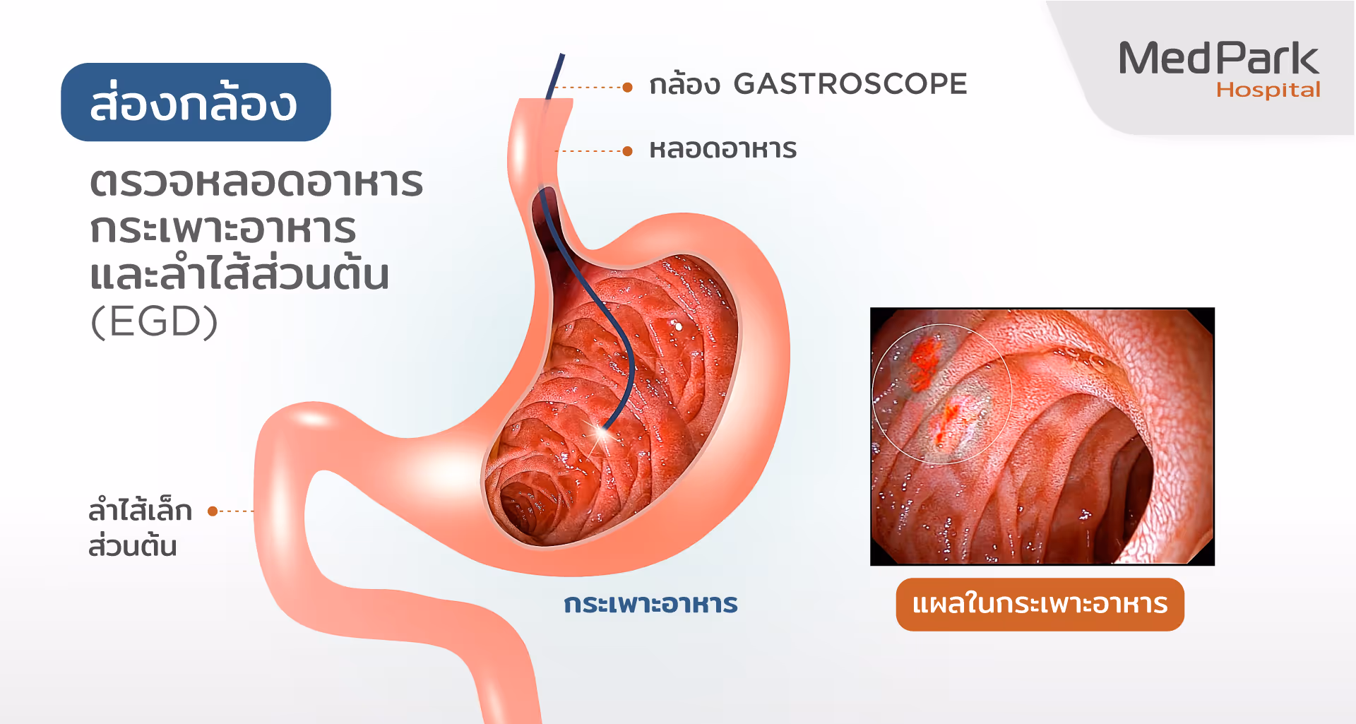 กรดไหลย้อน วินิจฉัยอย่างไร-How is GERD diagnosed?
