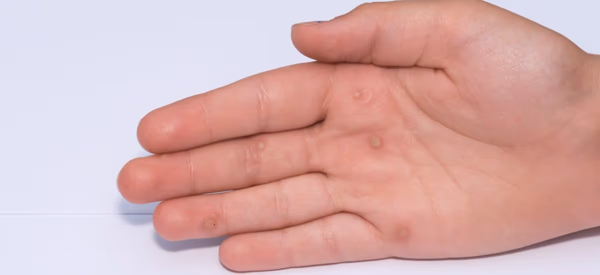 The human papillomavirus (HPV) is the cause of common warts. The viral infection can occur through breaks in the skin