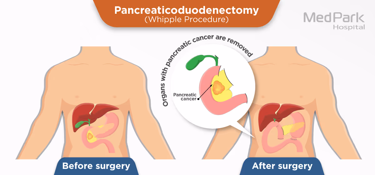Pancreatectomy En 02