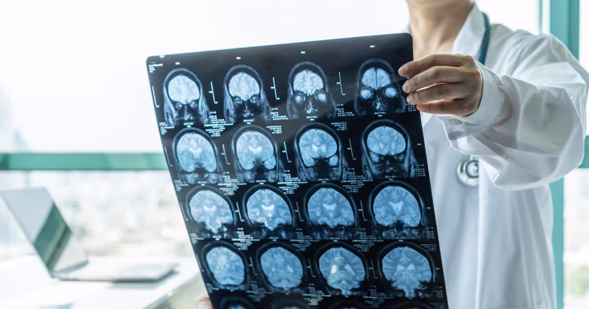 อาการ สาเหตุ การรักษาโรคเยื่อหุ้มสมองอักเสบ - Meningitis: Symptoms, Causes, and Treatment