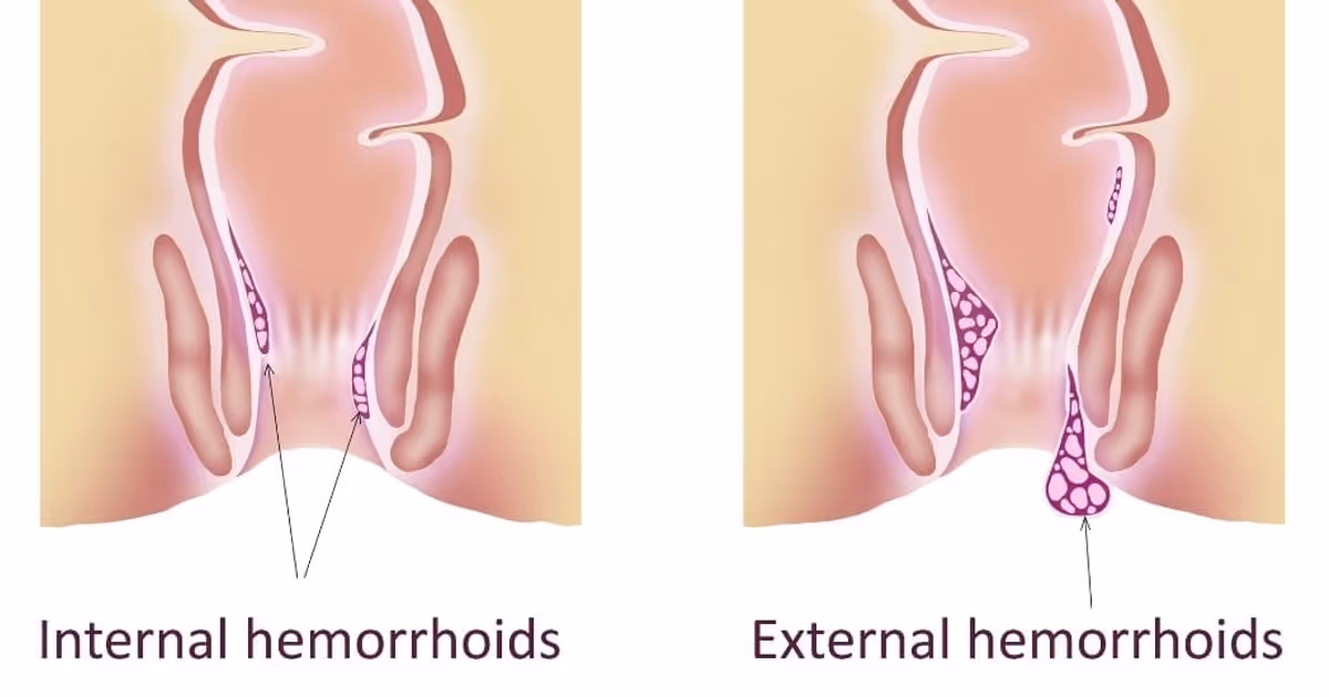 ลักษณะของริดสีดวงทวาร ภายในและภายนอก-Characteristics of hemorrhoids 