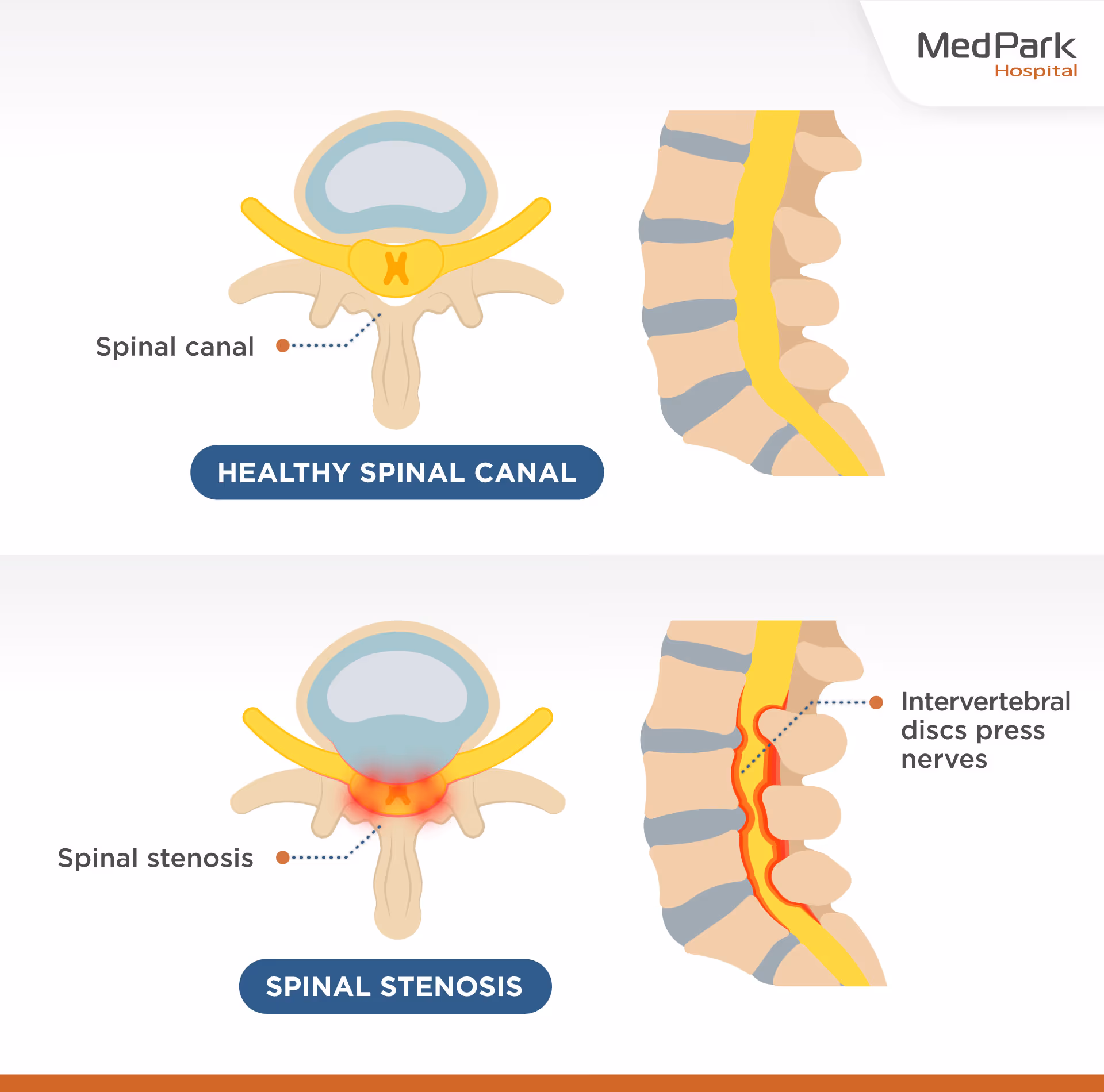 What Diseases Does Tlif Surgery Treat - ผ่าตัดเชื่อมข้อกระดูกสันหลังส่วนเอว Tlif รักษาโรคอะไร