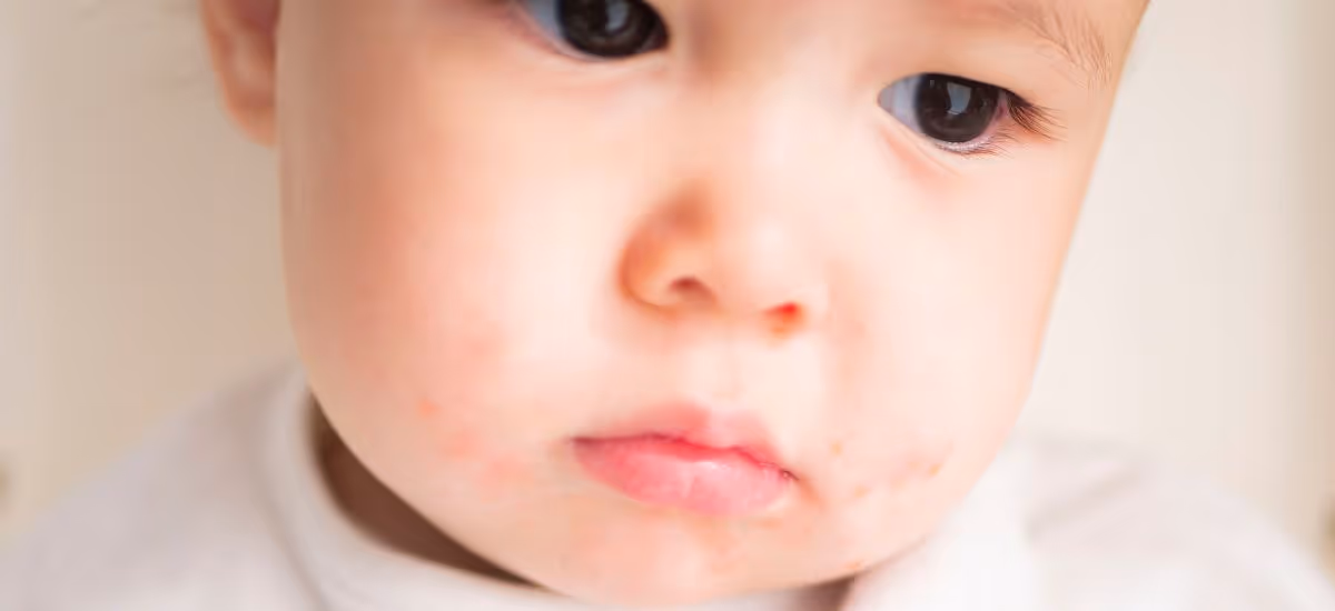  อาการ สาเหตุ การตรวจวินิจฉัย และการรักษาโรคมือ เท้า ปาก (Hand, Foot, and Mouth Disease)
