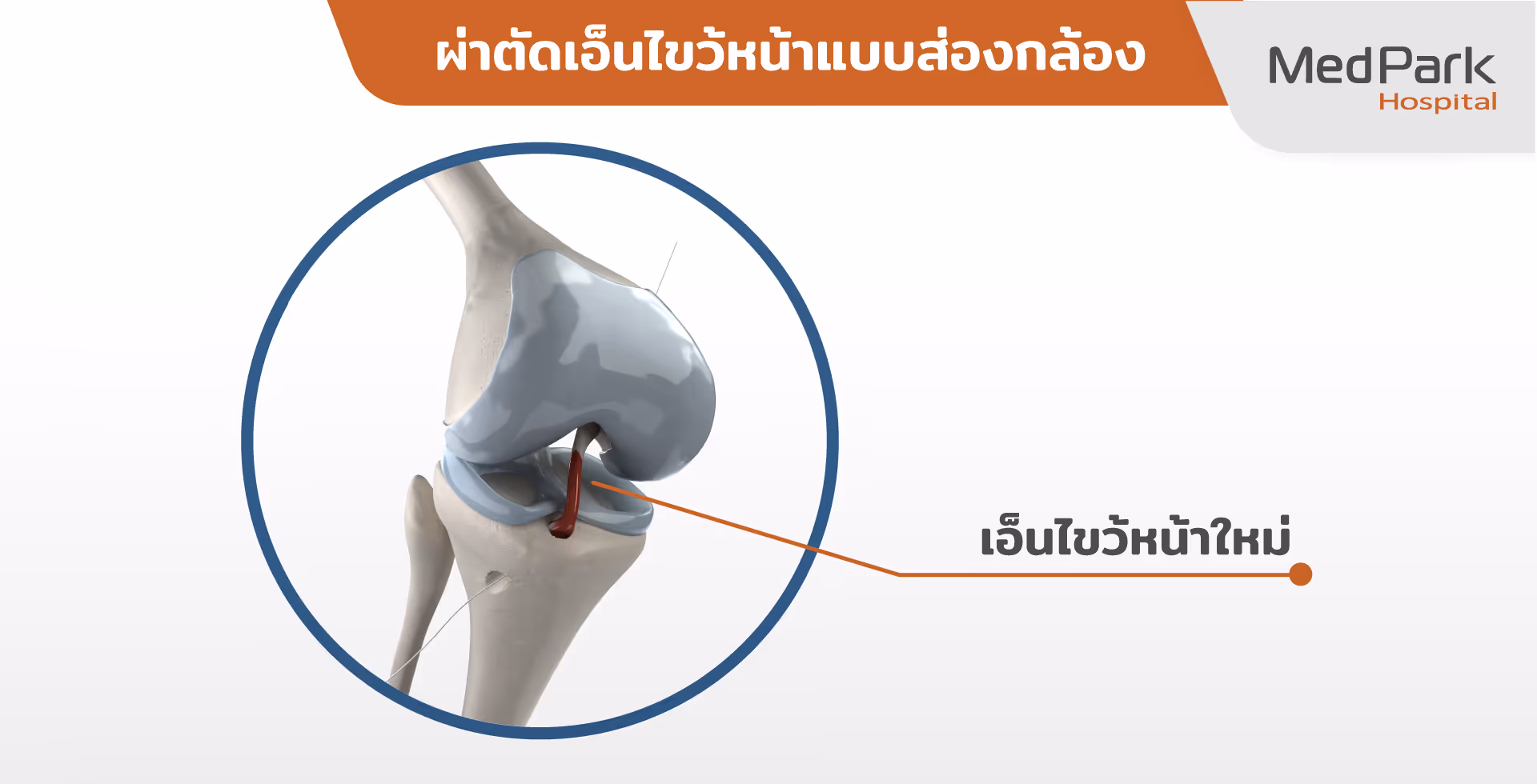 Acl Reconstruction (1 3)