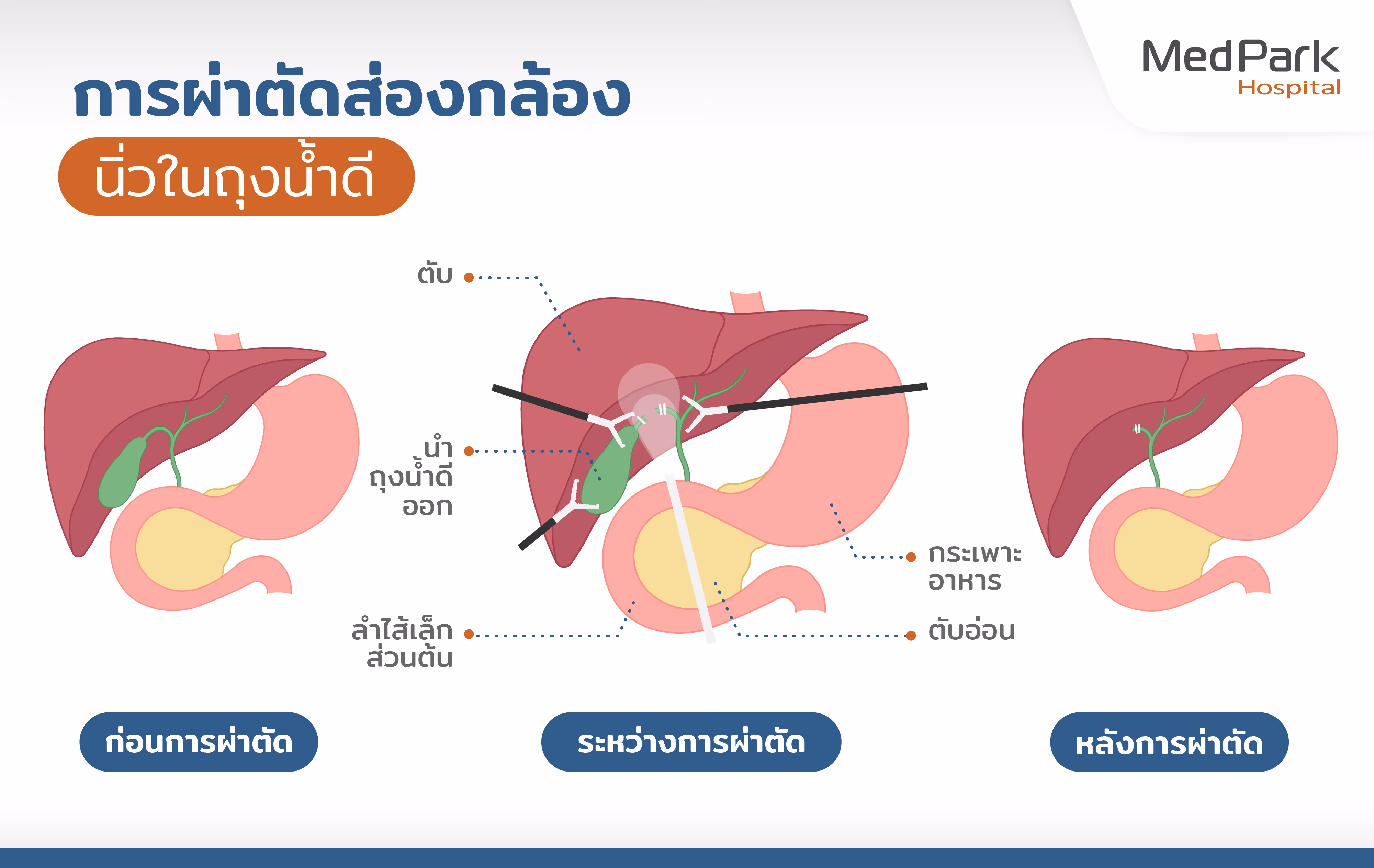 ขั้นตอนการผ่าตัดส่องกล้องนิ่วในถุงน้ำดี