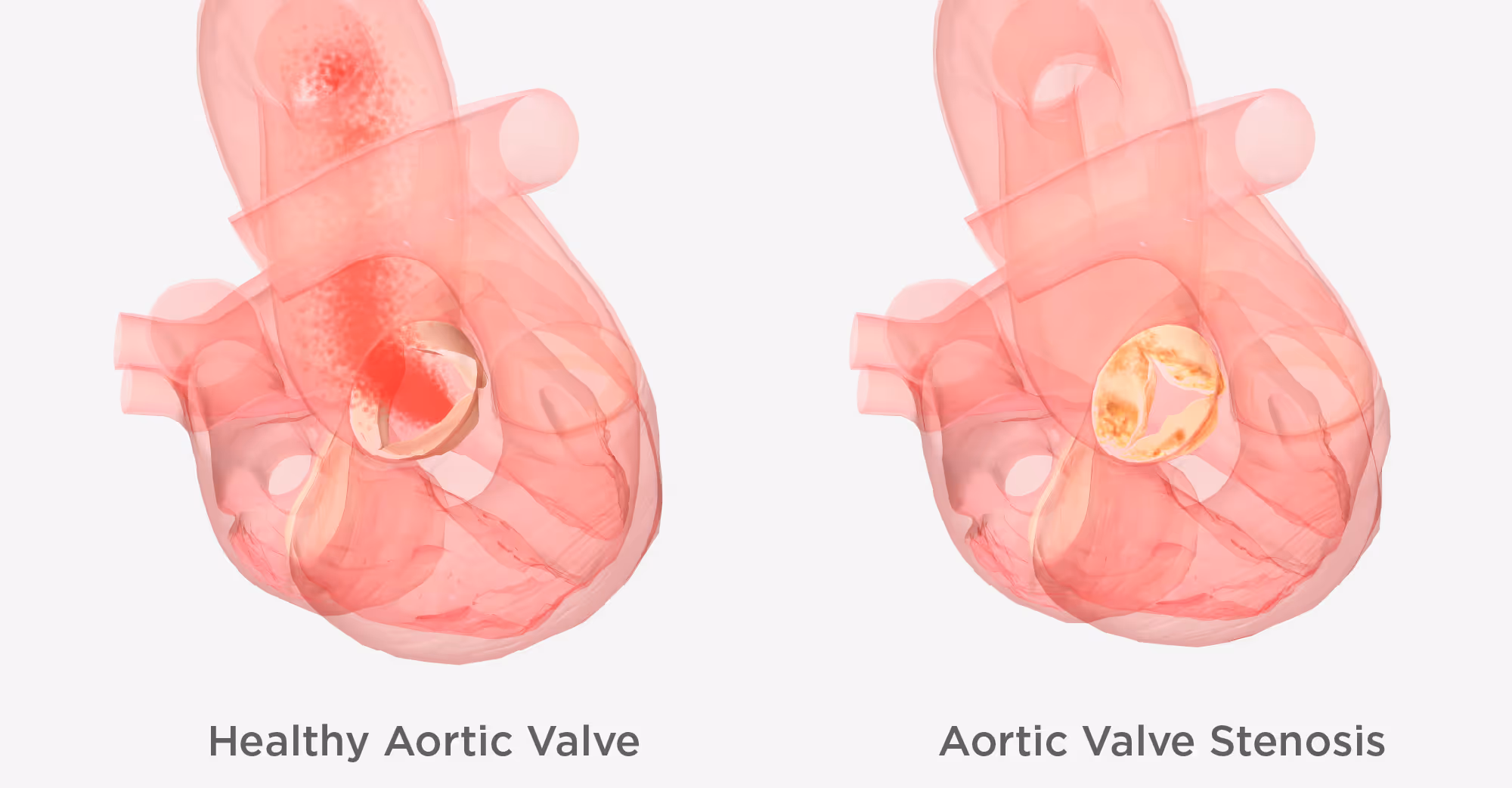 เปลี่ยนลิ้นหัวใจ ไม่ต้องผ่าตัด TAVI (Transcatheter aortic valve implantation)