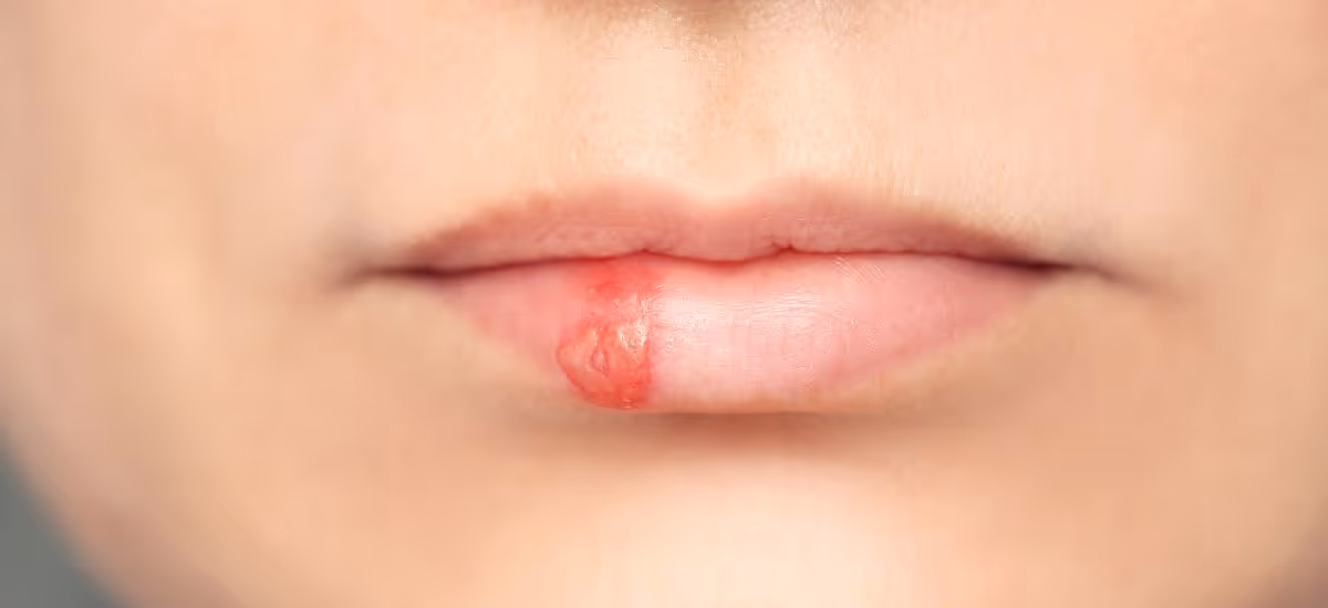 เริมแสดงอาการเริ่มต้นด้วยอาการคันยุบยิบบริเวณที่ติดเชื้อไวรัส HSV