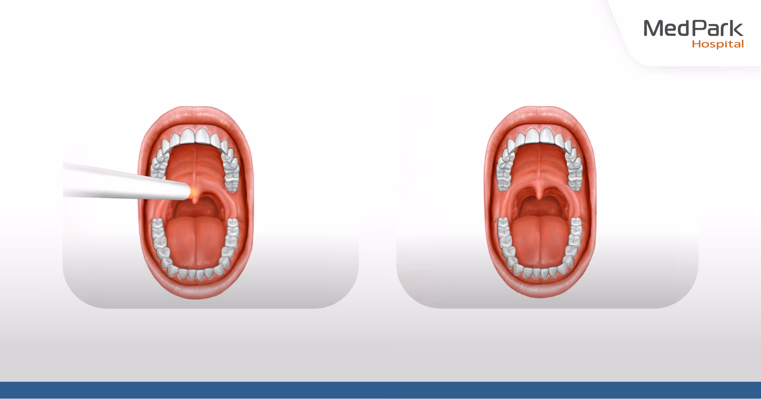 What is laser snoring treatment aftercare?