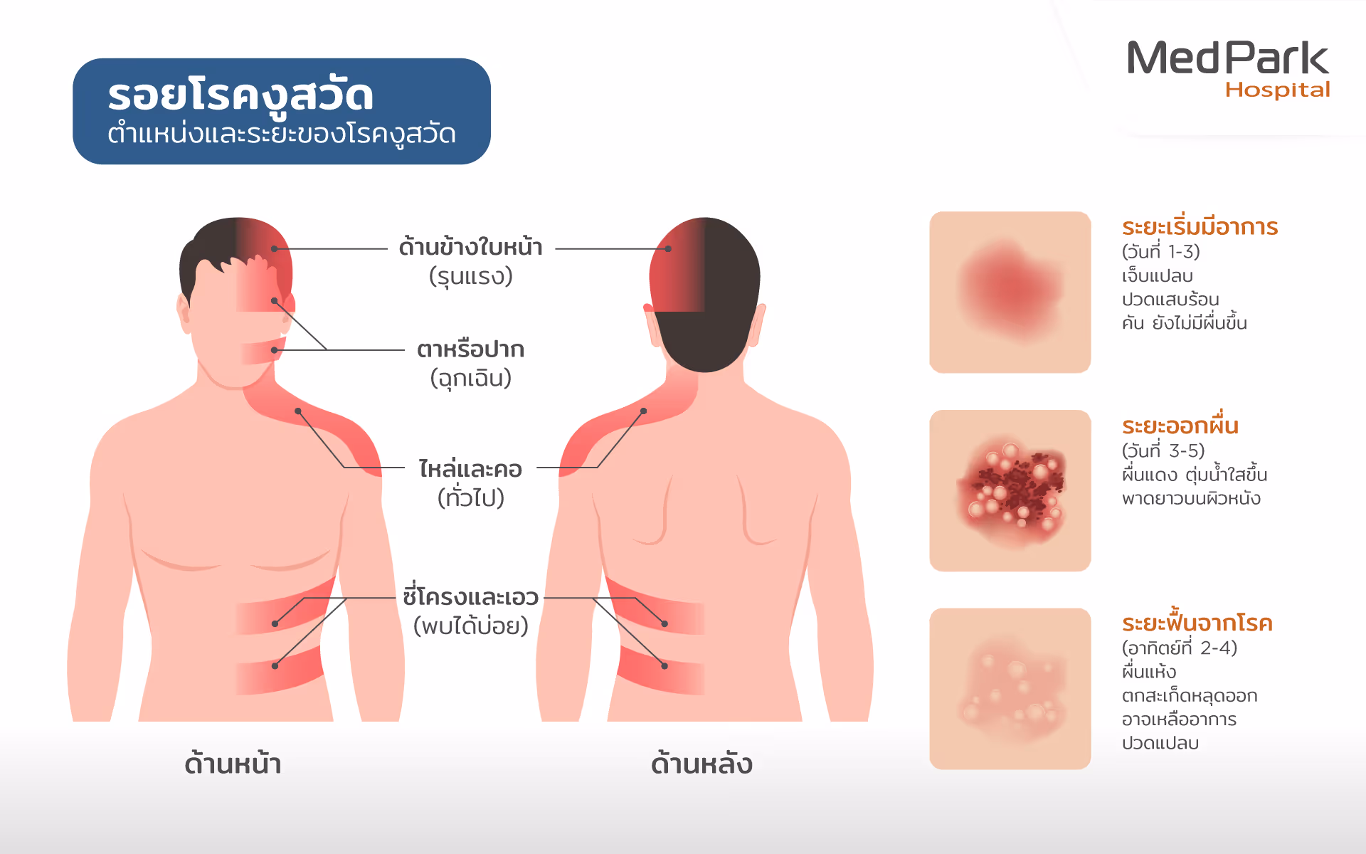 ระยะของโรคงูสวัด-stages of herpes zoster