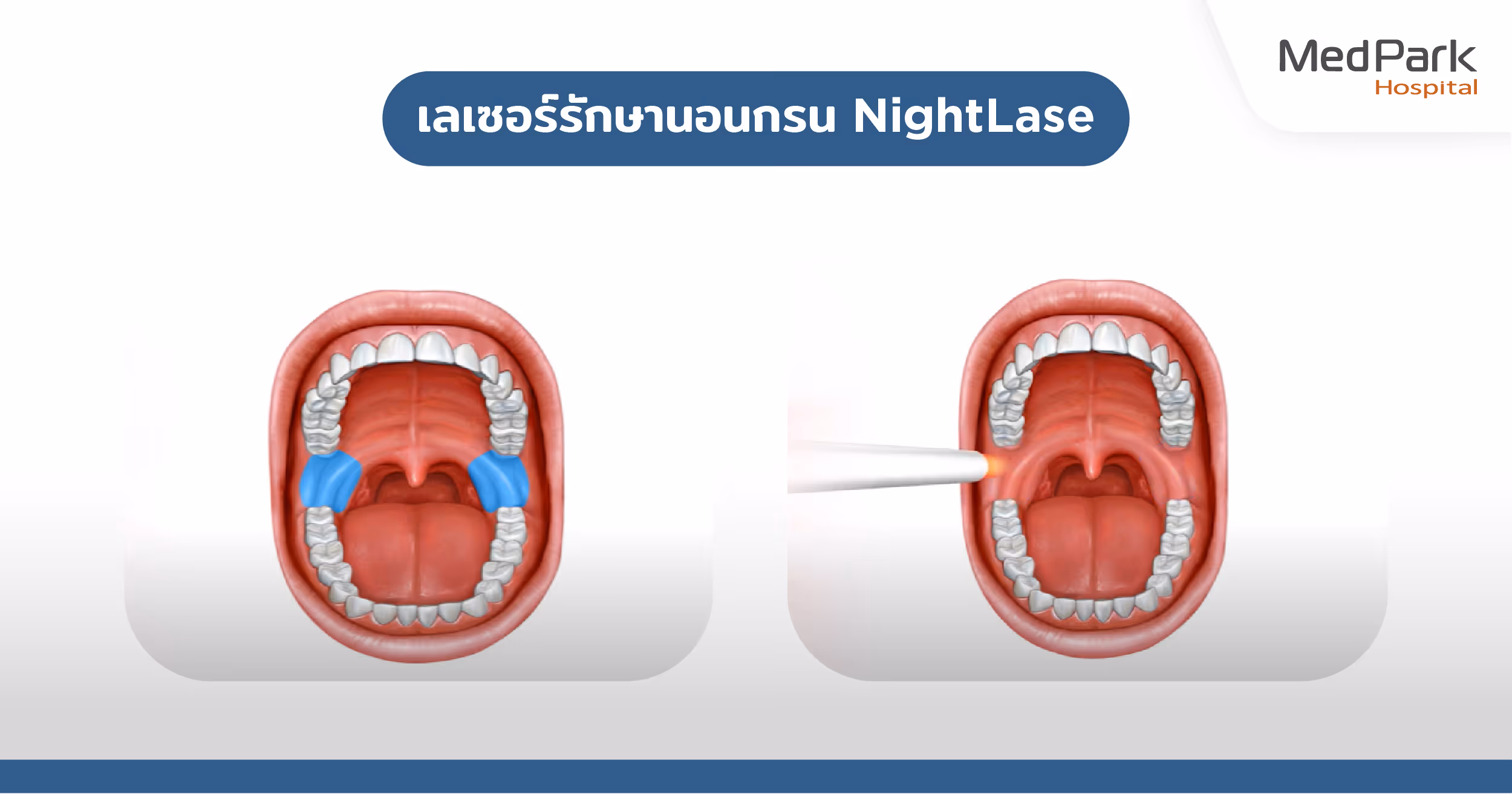 เลเซอร์รักษานอนกรน มีขั้นตอนอย่างไร