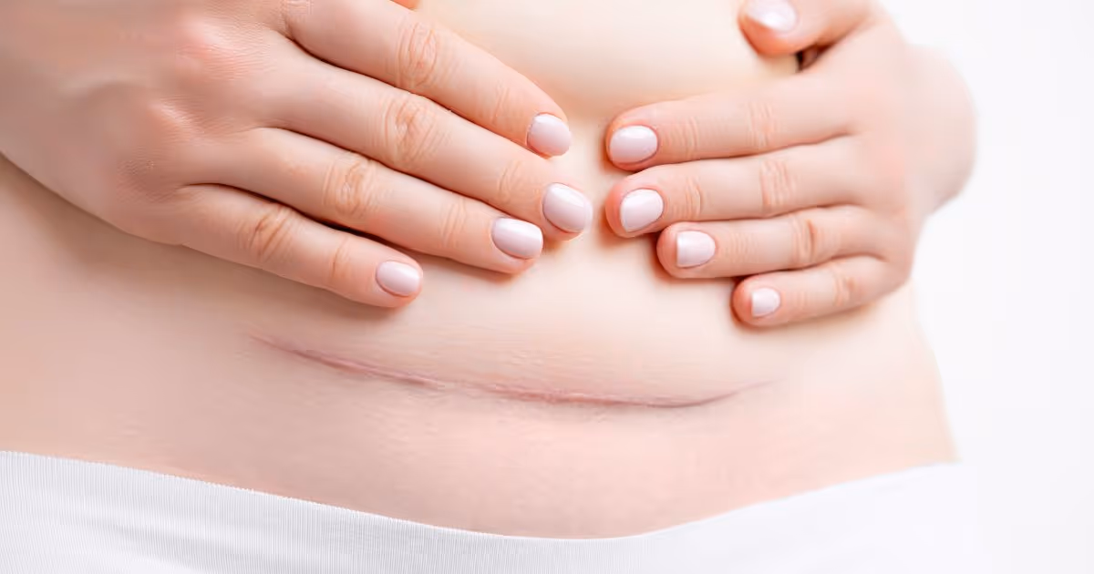 แผลคีลอยด์แบบไหน รักษาได้ด้วยการฉายแสง What types of keloid scars can be treated with radiation?