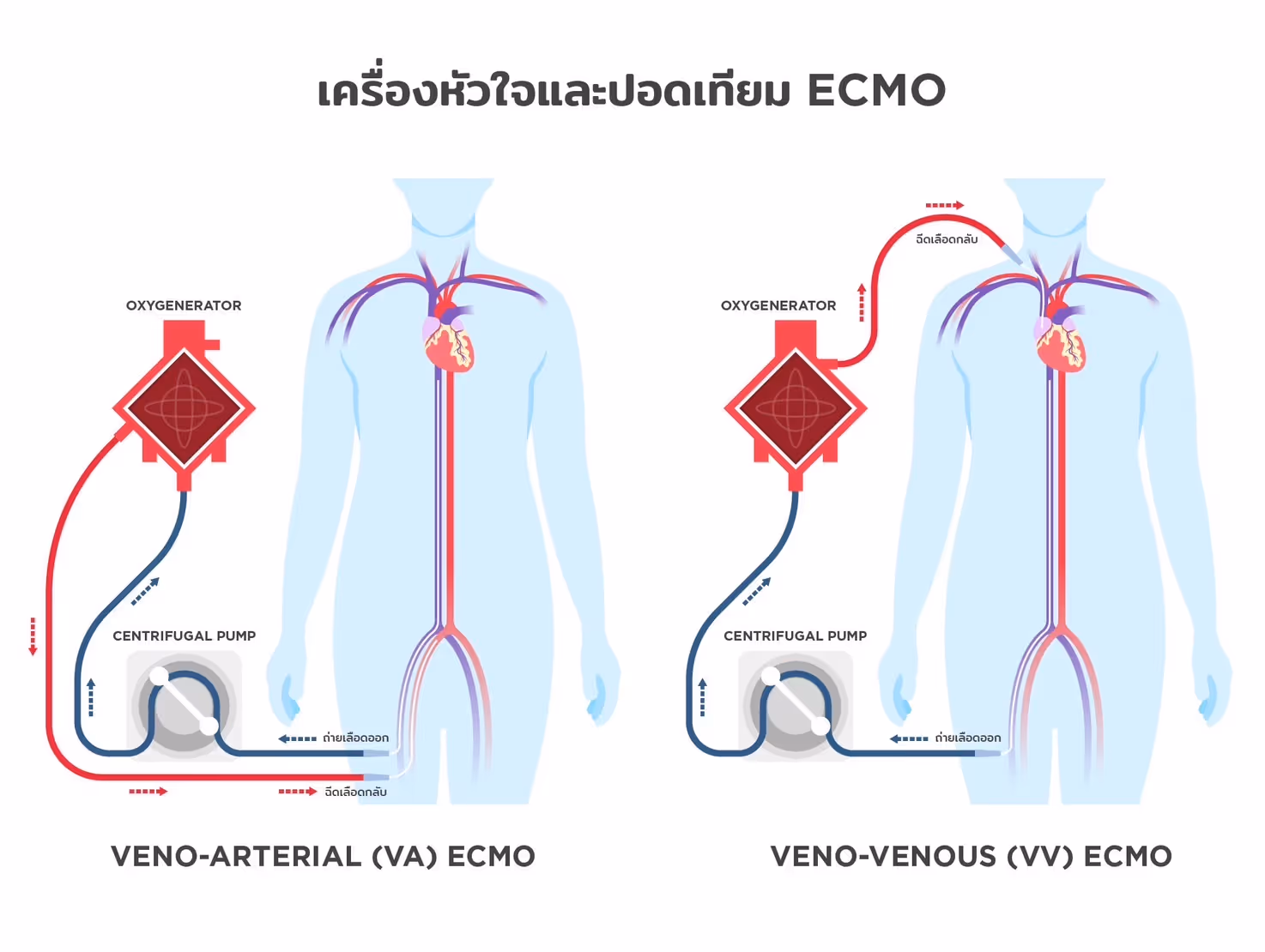 ัขั้นตอนการพยุงชีพด้วยเครื่อง ECMO