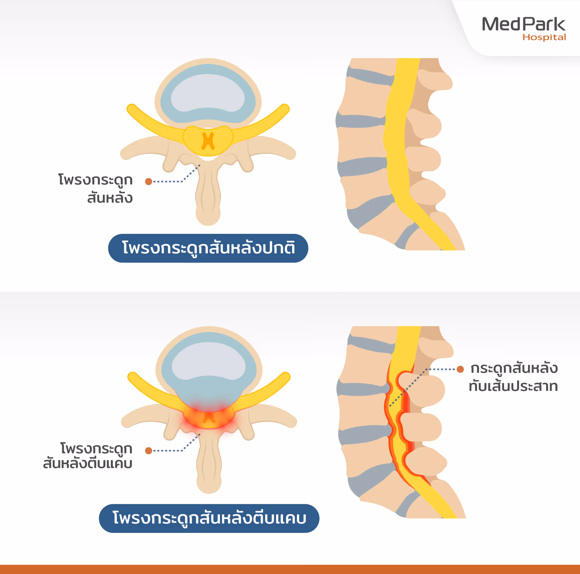 ผ่าตัดเชื่อมข้อกระดูกสันหลังส่วนเอว TLIF รักษาโรคอะไร - What diseases does TLIF surgery treat?