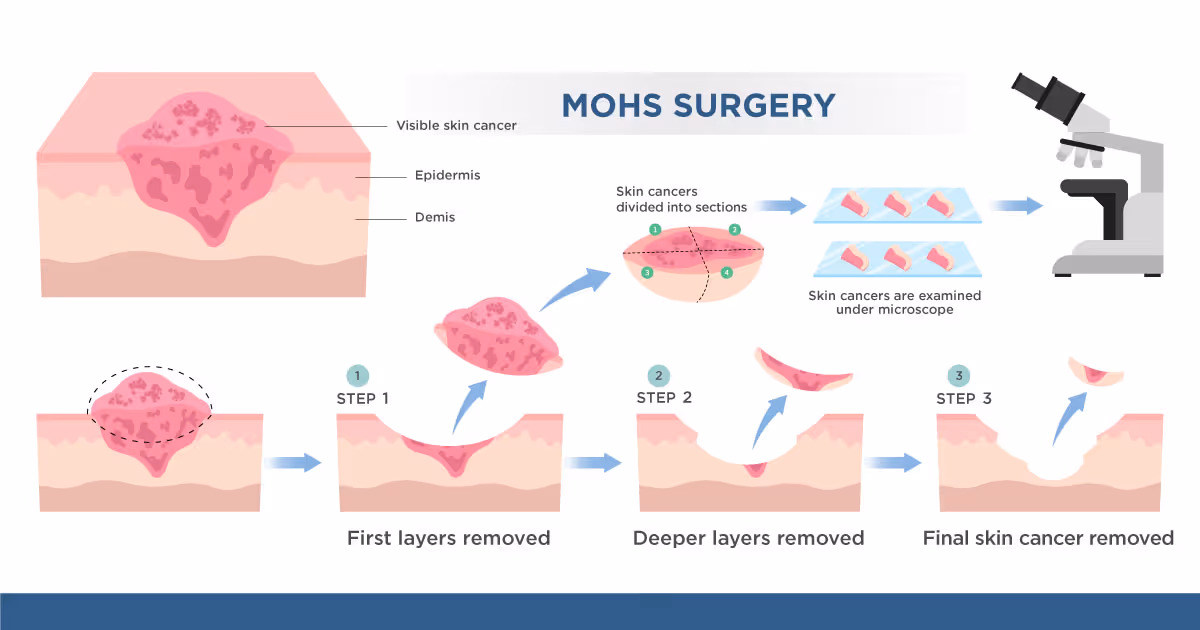 Mohs Surgery En